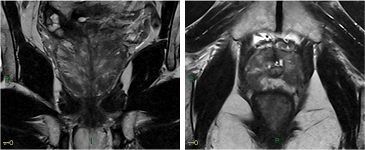 Case Report Late Relapse In Germ Cell Testicular Cancer American